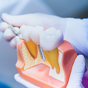 Kramer and Kramer Dental | Root Canals, Crowns amp Caps and Dental Fillings